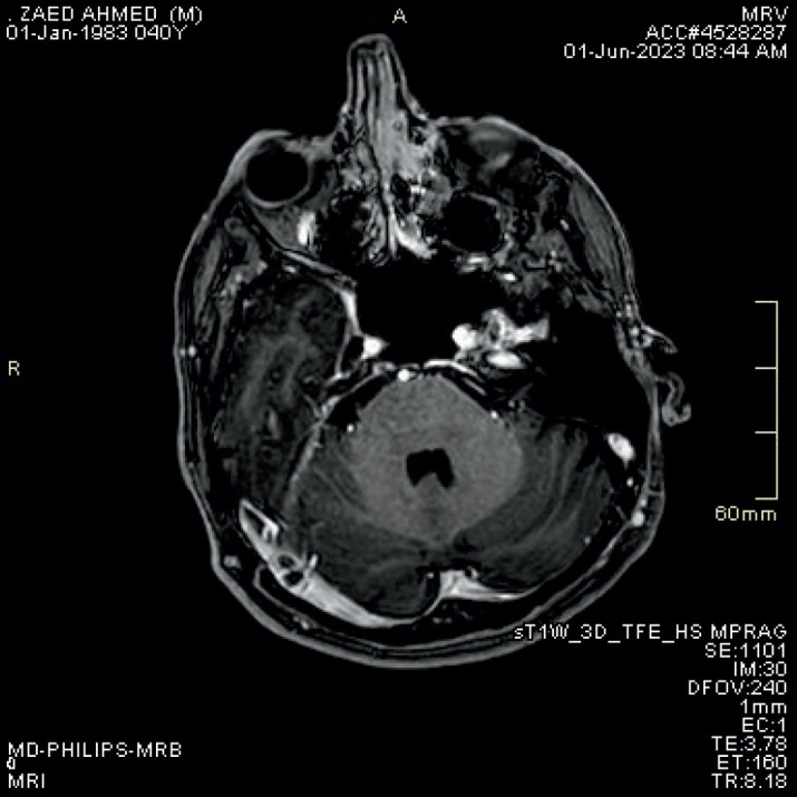 Post -contrast Three -dimensional MP RAGE T1WI Sequence Compared to Brain MRV Sequence for Diagnosing Brain Sinus Venous Thrombosis.
