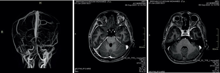 Post -contrast Three -dimensional MP RAGE T1WI Sequence Compared to Brain MRV Sequence for Diagnosing Brain Sinus Venous Thrombosis.