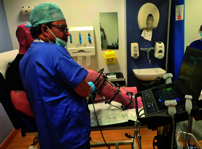 Circular External Fixator Removal in the Outpatient Clinic Using Regional Anaesthesia: A Pilot Study of a Novel Approach.