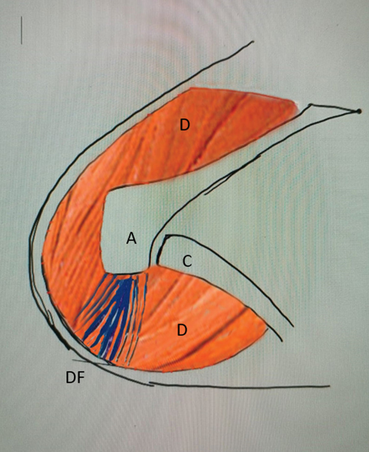 Combined latissimus dorsi transfer and deltoid flap for irreparable rotator cuff tear: A retrospective analysis.