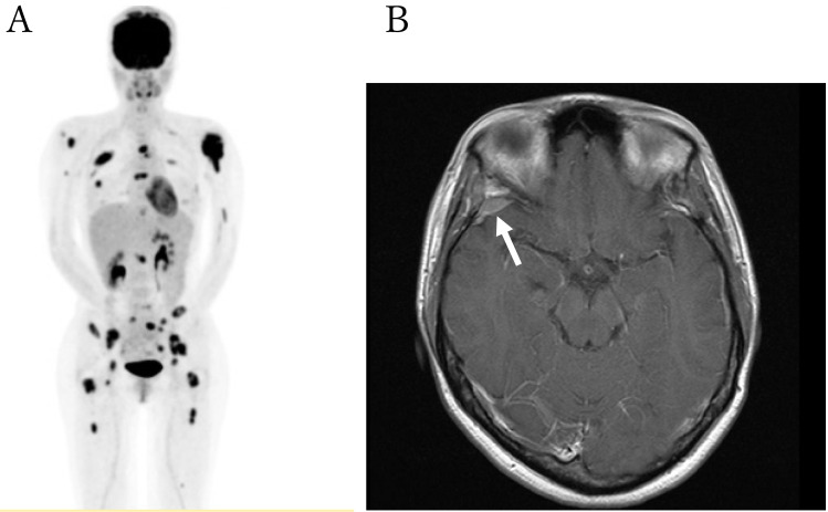Methotrexate-induced subacute myelopathy: a serious but treatable complication.