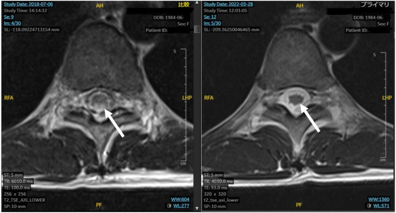 Methotrexate-induced subacute myelopathy: a serious but treatable complication.