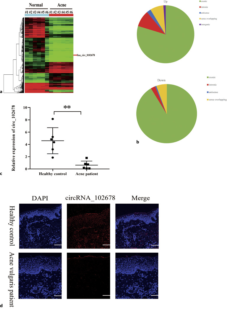 YTHDC1-Modified m6A Methylation of Hsa_circ_0102678 Promotes Keratinocyte Inflammation Induced by Cutibacterium acnes Biofilm through Regulating miR-146a/TRAF6 and IRAK1 Axis.