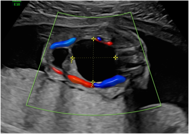 Antenatal and histological diagnostics of cystic sacrococcygeal teratoma. Clinical case and literature review.