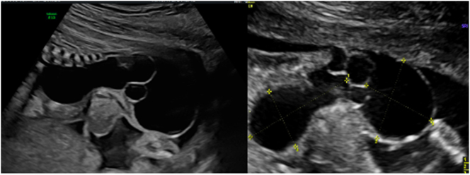 Antenatal and histological diagnostics of cystic sacrococcygeal teratoma. Clinical case and literature review.