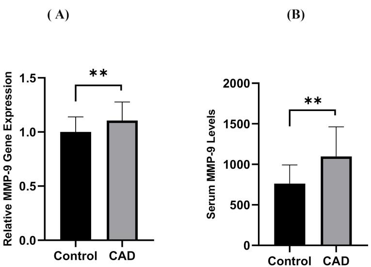 Evaluation of MMP-9, IL-6, TNF-α levels and peripheral blood mononuclear cells genes expression of MMP-9 and TIMP-1 in Iranian patients with coronary artery disease.