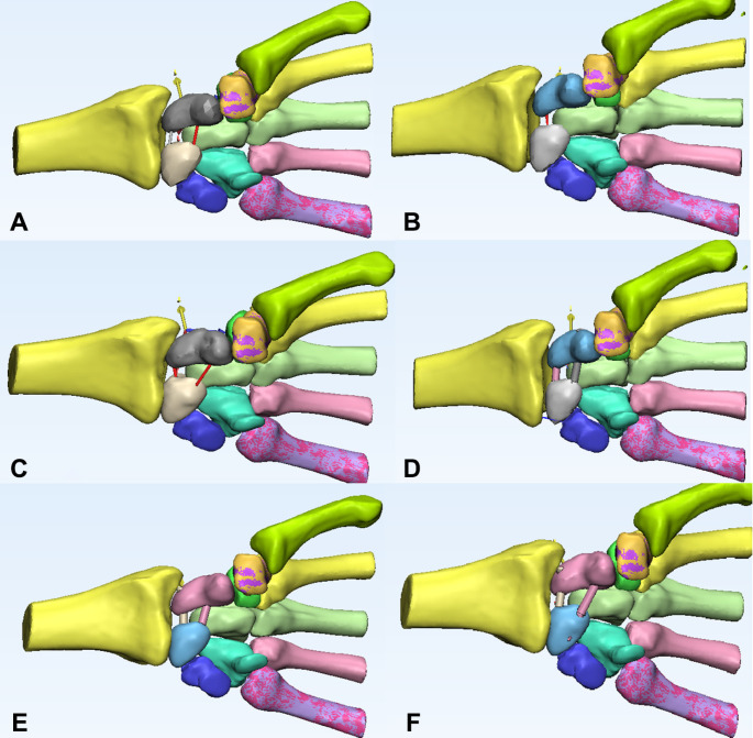 Evaluation of Various Fixation Methods in Acute Scapholunate Dissociation, A Finite Element Study.