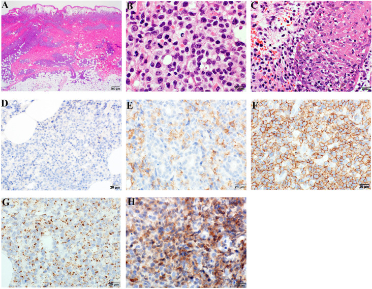 Coincidence of de novo T-lymphoblastic lymphoma and cutaneous gamma/delta peripheral T-cell lymphoma.