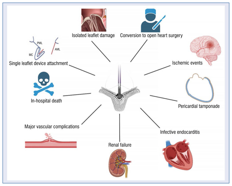 Complications following transcatheter edge-to-edge mitral valve repair: Personal experience and review of the literature.