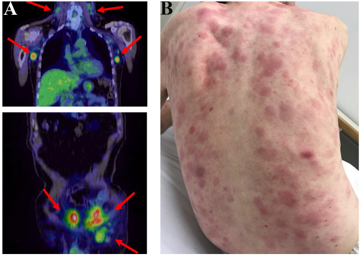 Coincidence of de novo T-lymphoblastic lymphoma and cutaneous gamma/delta peripheral T-cell lymphoma.