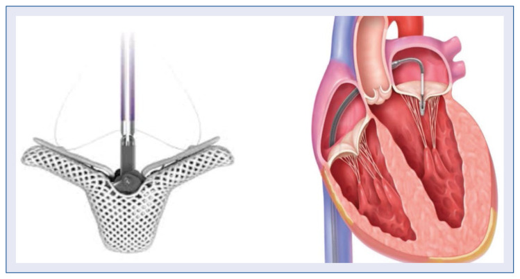 Complications following transcatheter edge-to-edge mitral valve repair: Personal experience and review of the literature.