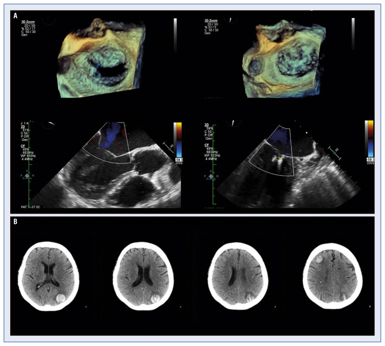 Complications following transcatheter edge-to-edge mitral valve repair: Personal experience and review of the literature.