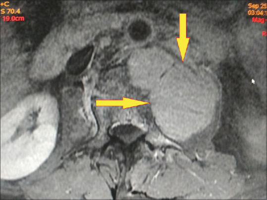 Concomitant Hodgkin's Lymphoma in a Patient with Tuberculous Spondylitis.