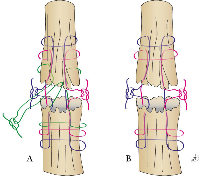 Comparison of Six-strand and Four-strand Techniques on the Repair of Injured Deep Flexor Tendons of Zone II of the Hand: A Randomized Controlled Clinical Trial.