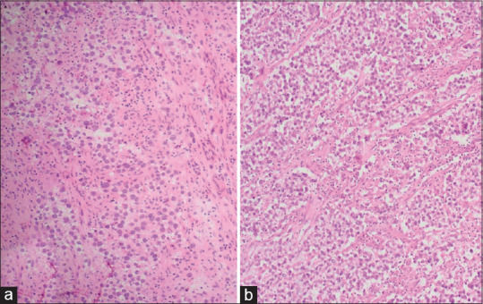 A Critical Appraisal of Intraoperative Frozen Section Analysis of Ovarian Tumors: A 3-Year Review of Accuracy and Clinicopathological Correlation at a Tertiary Care Center.