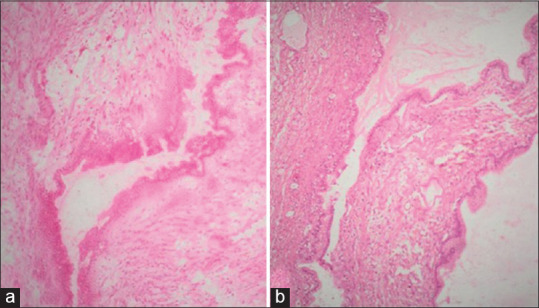 A Critical Appraisal of Intraoperative Frozen Section Analysis of Ovarian Tumors: A 3-Year Review of Accuracy and Clinicopathological Correlation at a Tertiary Care Center.