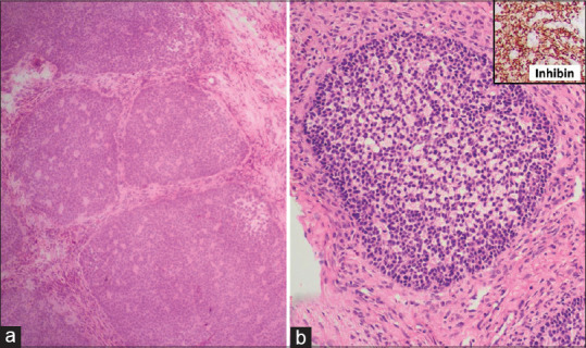 A Critical Appraisal of Intraoperative Frozen Section Analysis of Ovarian Tumors: A 3-Year Review of Accuracy and Clinicopathological Correlation at a Tertiary Care Center.