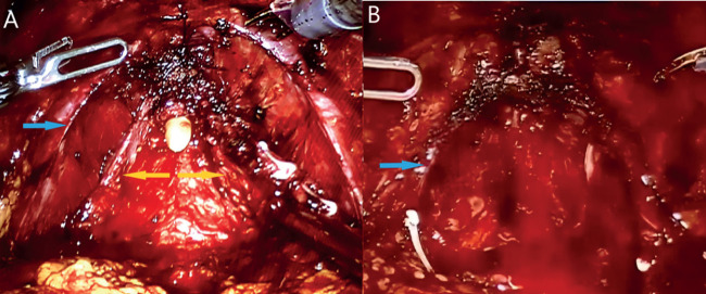 Optimizing Nerve Sparing in Robotic-Assisted Radical Prostatectomy: A Comparative Investigation of Traditional and Modified Endopelvic Fascia Preservation Techniques.
