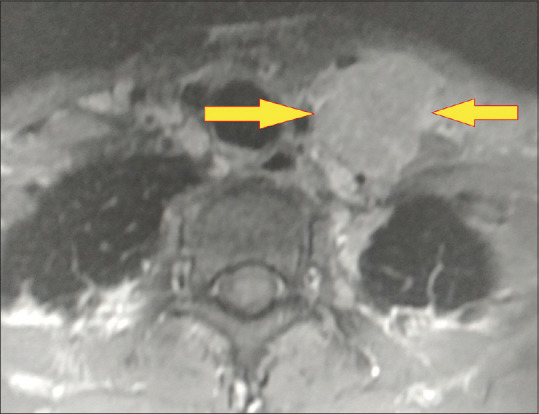 Concomitant Hodgkin's Lymphoma in a Patient with Tuberculous Spondylitis.