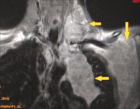Concomitant Hodgkin's Lymphoma in a Patient with Tuberculous Spondylitis.