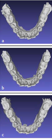 Posterior Dahl: A Minimally Invasive Method for the Treatment of Localized Posterior Tooth Wear.