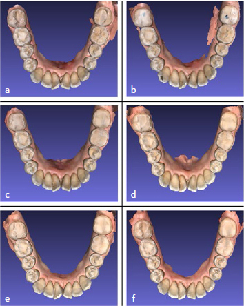 Posterior Dahl: A Minimally Invasive Method for the Treatment of Localized Posterior Tooth Wear.