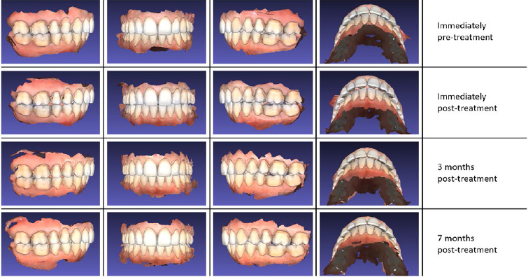 Posterior Dahl: A Minimally Invasive Method for the Treatment of Localized Posterior Tooth Wear.