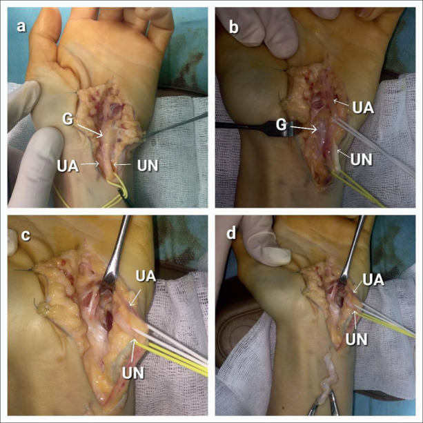 Compression of Ulnar Nerve by Ganglion Cyst in Guyon's Canal-a Case Report.