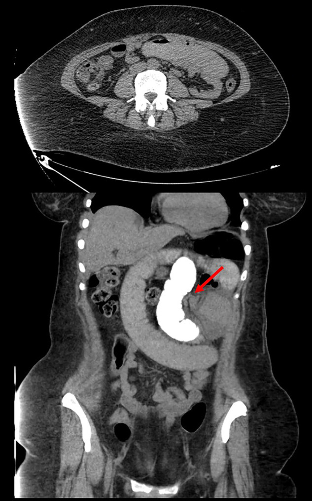 Multiple Internal Hernias: A Complication of Laparoscopic Roux-en-Y Gastric Bypass.