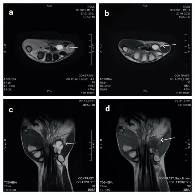 Compression of Ulnar Nerve by Ganglion Cyst in Guyon's Canal-a Case Report.