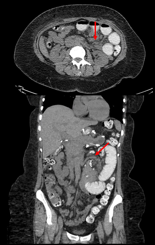 Multiple Internal Hernias: A Complication of Laparoscopic Roux-en-Y Gastric Bypass.