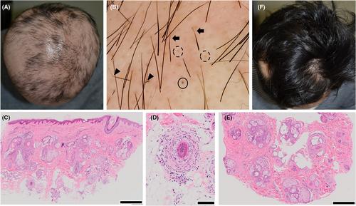 A case of extensive alopecia areata following Pfizer-BioNTech BNT162b2 mRNA COVID-19 vaccine with favorable outcome