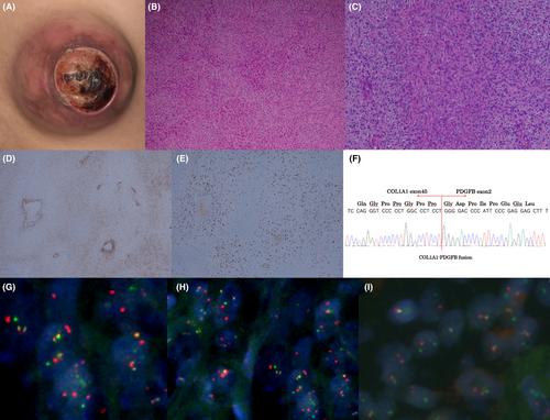 Possible role of the collagen type I alpha 1–platelet-derived growth factor beta chain fusion gene in the development of dermatofibrosarcoma protuberans with fibrosarcomatous transformation