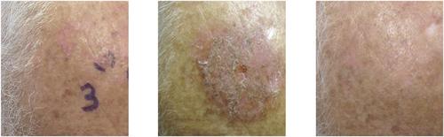 Superficial radiation therapy for nonmelanoma skin cancer: A review