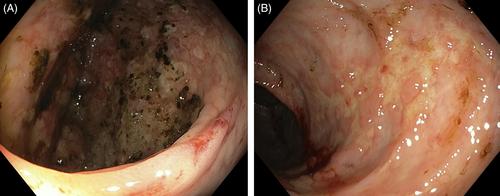 Colonic injury from a commonly prescribed medication