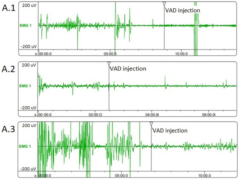 A possible mechanism of erectile dysfunction in coronavirus disease-19: Cavernosal smooth muscle damage: A pilot study