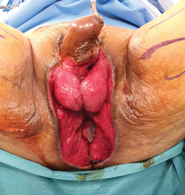 Dynamic Reconstruction of Anal Sphincter with Camera Shutter Style Double-Opposing Gracilis Flaps.