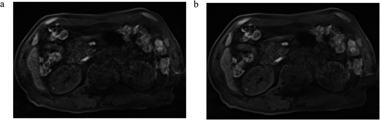 Optimal Temporal Resolution to Achieve Good Image Quality and Perform Pharmacokinetic Analysis in Free-breathing Dynamic Contrast-enhanced MR Imaging of the Pancreas.