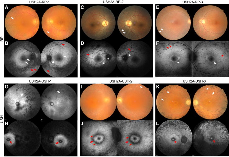 <i>USH2A</i> variants causing retinitis pigmentosa or Usher syndrome provoke differential retinal phenotypes in disease-specific organoids.