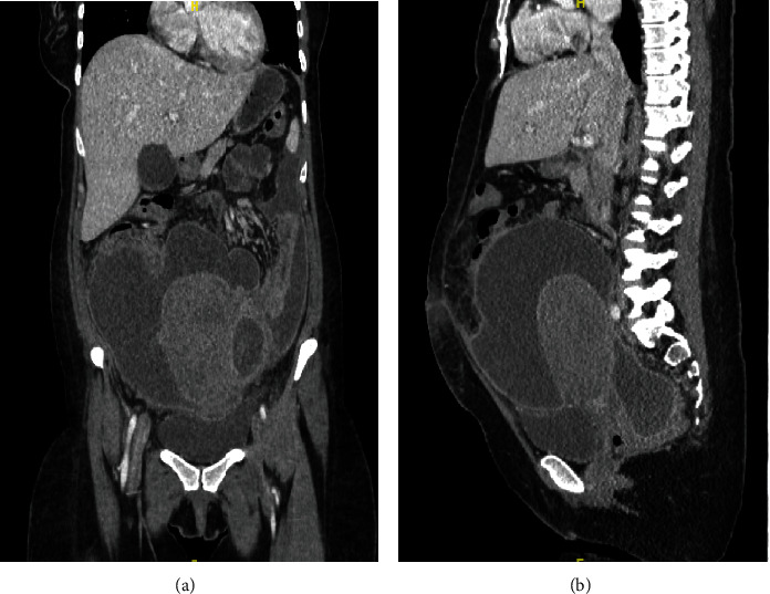 Uterine Rupture Secondary to Pyomyoma, Leading to Intra-Abdominal Abscesses following an Uncomplicated Vaginal Delivery.