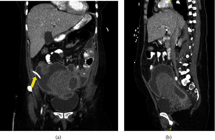 Uterine Rupture Secondary to Pyomyoma, Leading to Intra-Abdominal Abscesses following an Uncomplicated Vaginal Delivery.