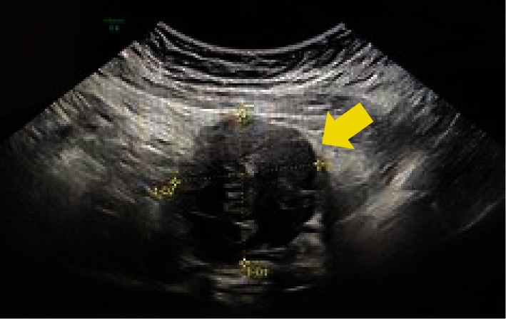 Uterine Rupture Secondary to Pyomyoma, Leading to Intra-Abdominal Abscesses following an Uncomplicated Vaginal Delivery.