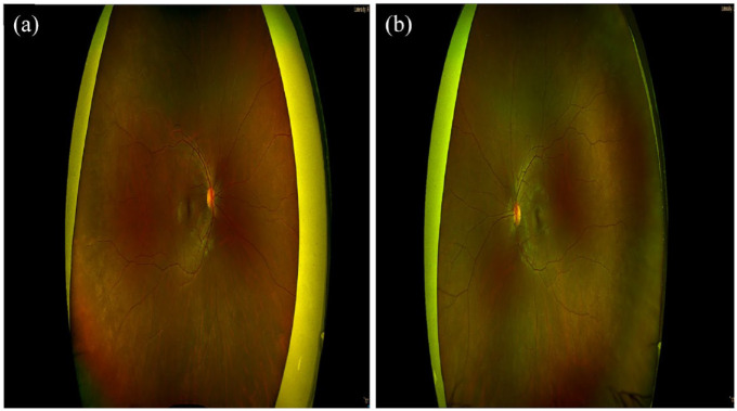 COVID-19 - a potential trigger for MOGAD-associated optic neuritis: a case report and literature review.