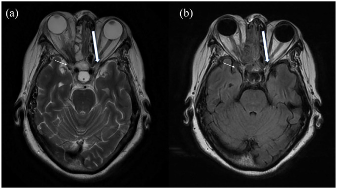 COVID-19 - a potential trigger for MOGAD-associated optic neuritis: a case report and literature review.