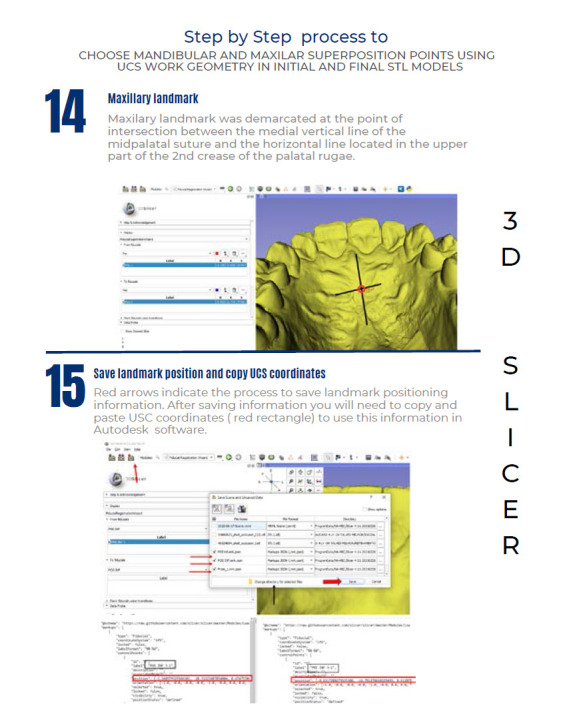 A new way of analyzing tooth movement using universal coordinate system geometry single point superposition in a 3D model.