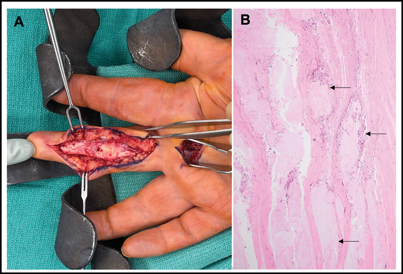 Flexor Tendon Rupture Secondary to Gout.