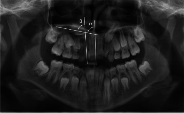 Maxillary canine position of patients with non-syndromic craniofacial disorder: a retrospective evaluation of panoramic radiographs.