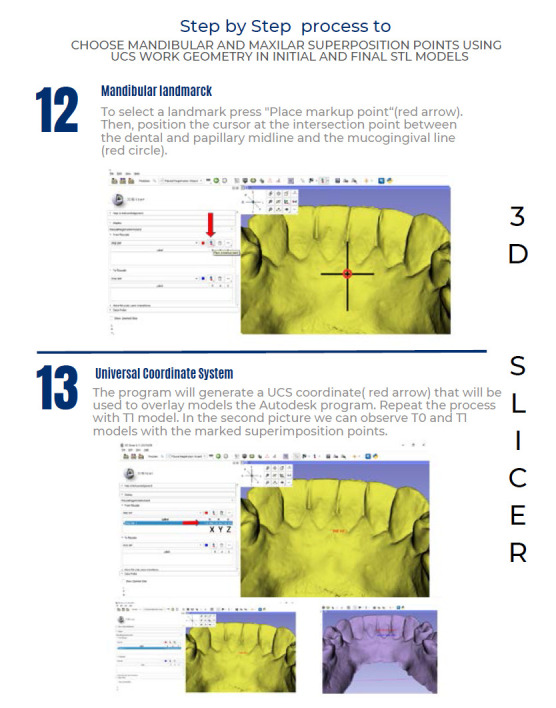 A new way of analyzing tooth movement using universal coordinate system geometry single point superposition in a 3D model.