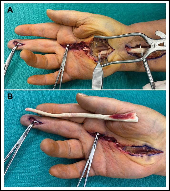 Flexor Tendon Rupture Secondary to Gout.