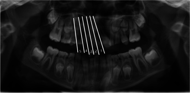 Maxillary canine position of patients with non-syndromic craniofacial disorder: a retrospective evaluation of panoramic radiographs.